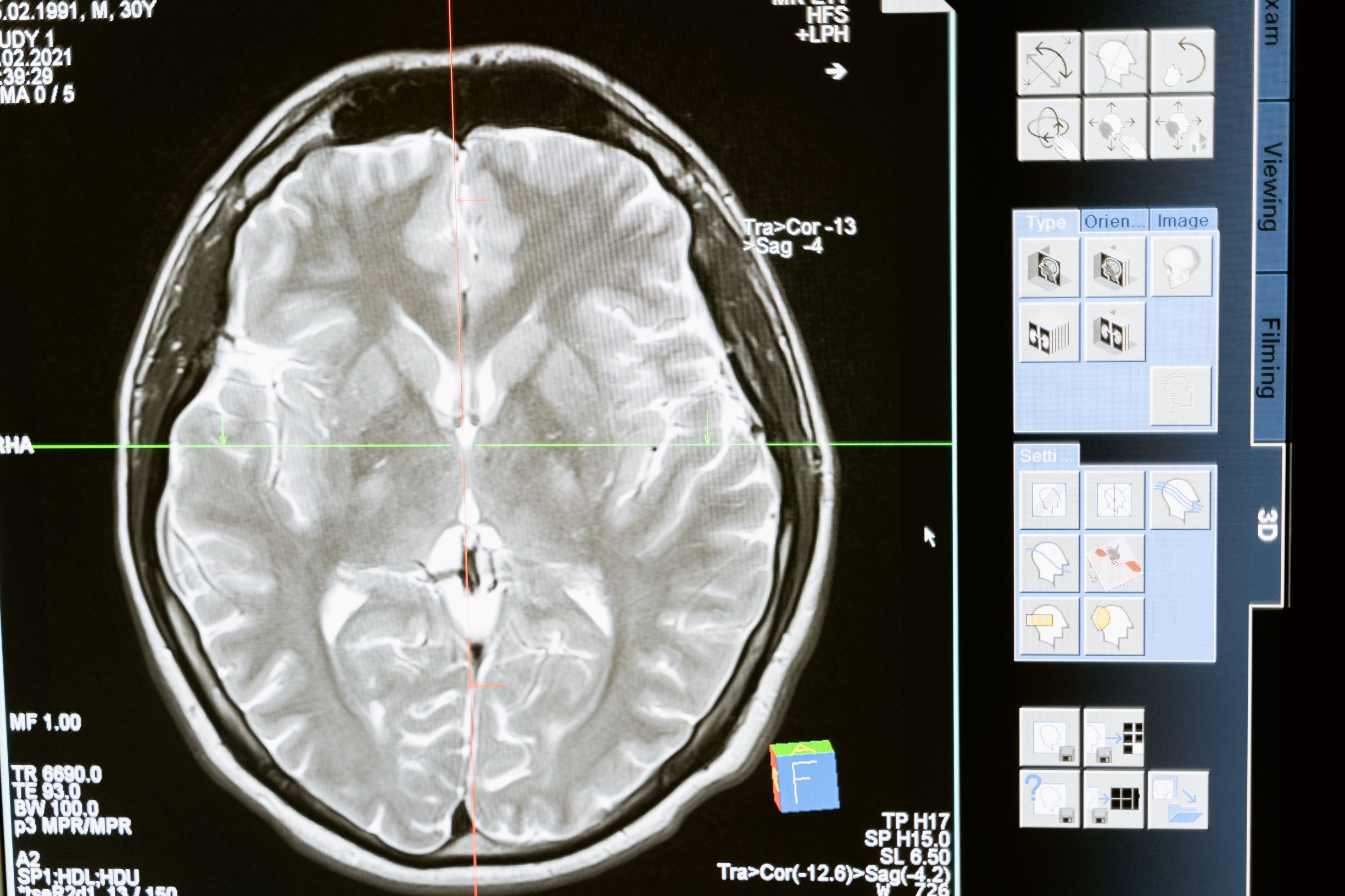 no safe level of alcohol for brain health